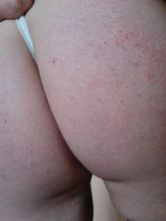 świeżo po depilacji