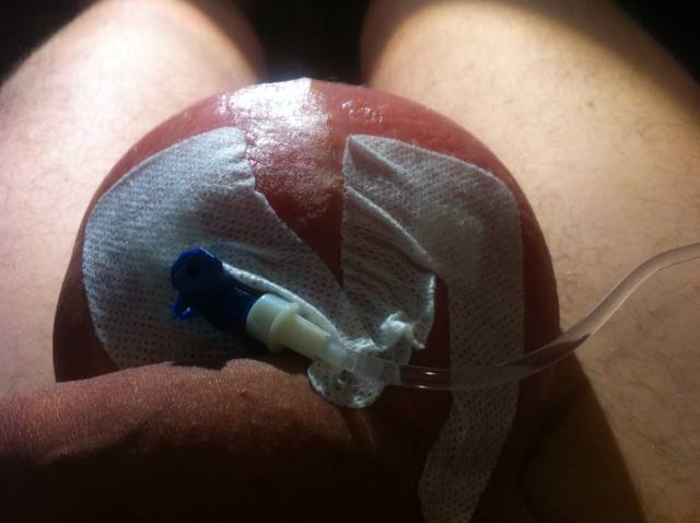 in progesss - RATCVAC