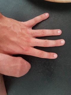 Uderzyłem się młotkiem w kciuk i strasznie spuchł... Co robi