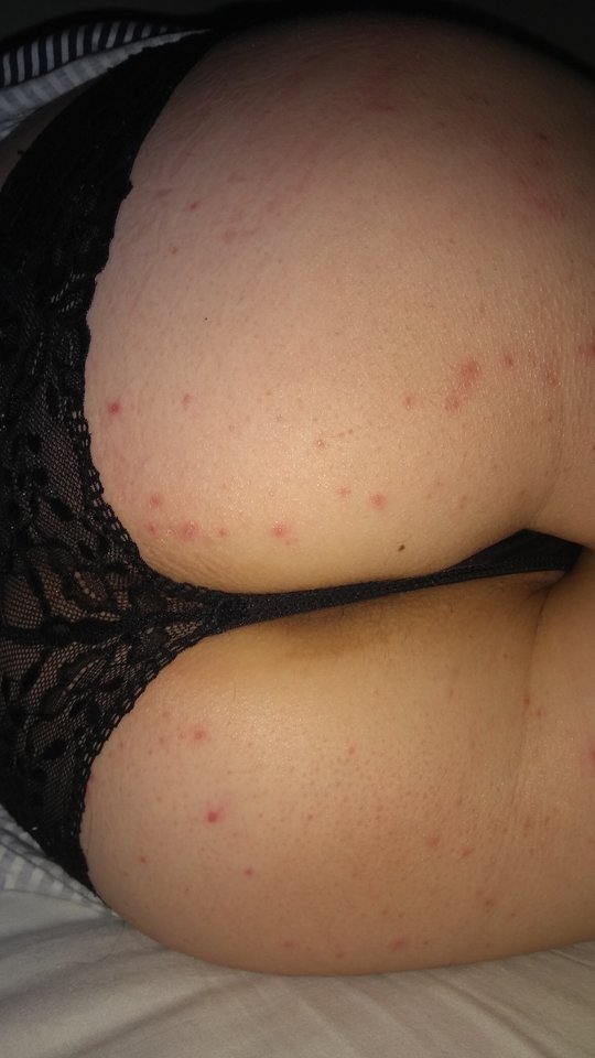 Uczulił o od słońca, czy od nadmiernego dawania dupy...??? - braviaex